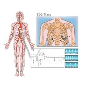 Ecg trace